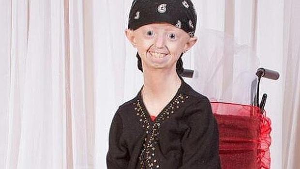Haley Okines, activista británica con progeria fallecida el pasado mes de abril a los 17 años de edad